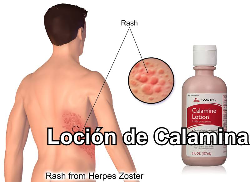 tratar el herpes zóster con calamina